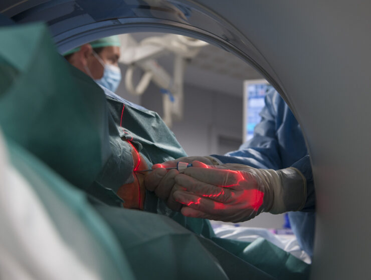 El Hospital de Bellvitge de Barcelona trata tumores mediante técnica de congelamiento